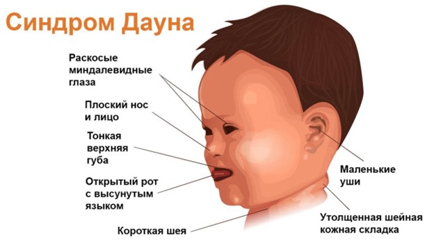 Даун синдромы бар бала туудың қауіп факторлары/Факторы риска рождения ребенка с синдромом Дауна