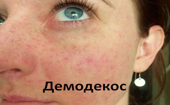 Демодекоз